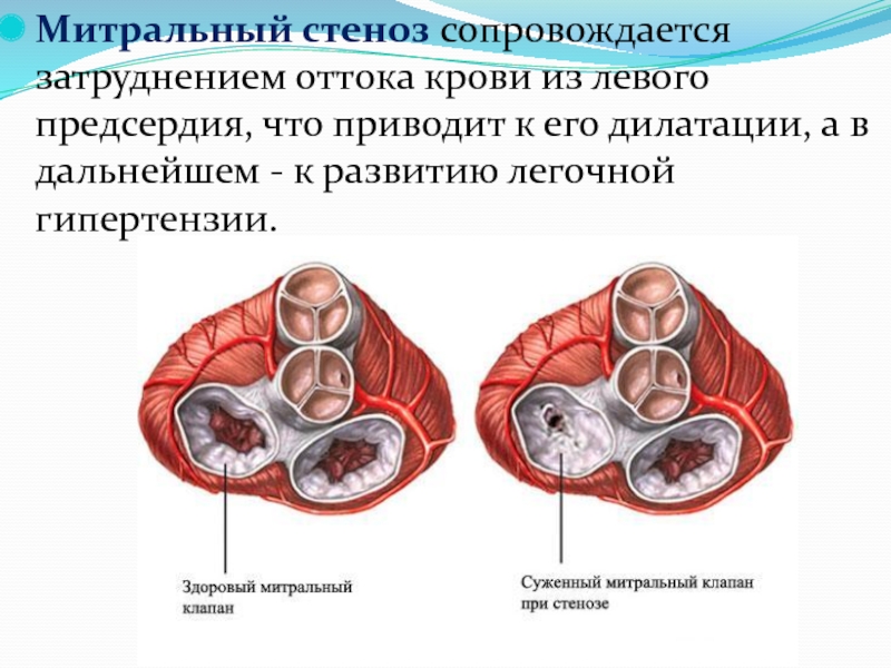 Митральный стеноз картинка