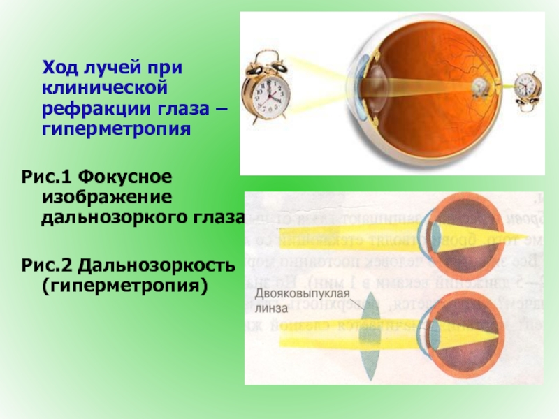 Гиперметропия 3 степени