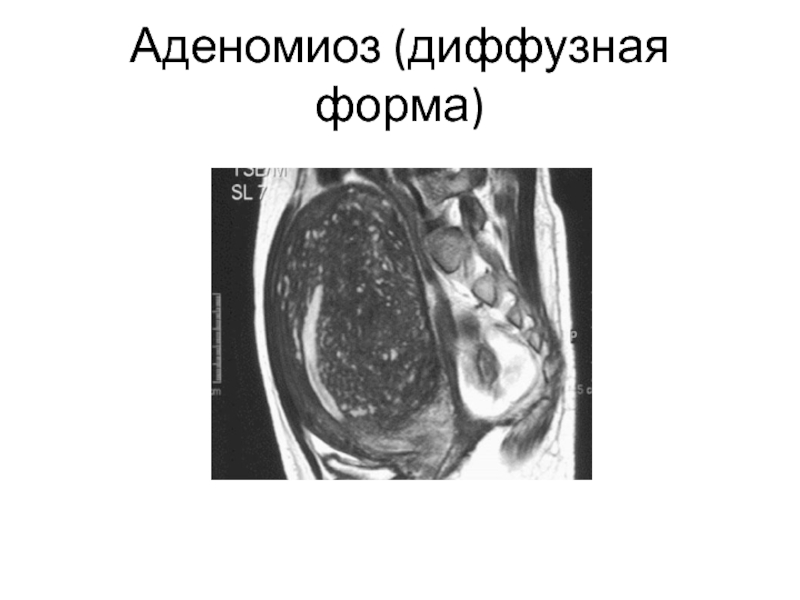 Аденомиоз матки это