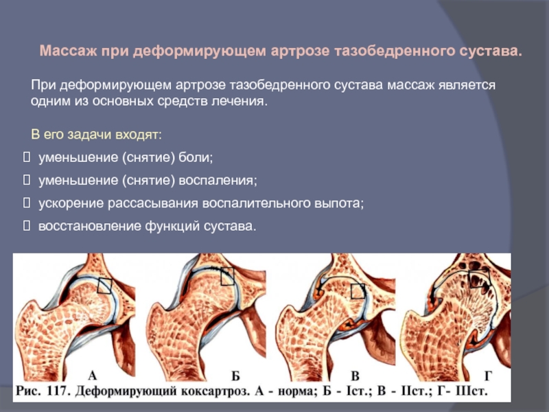 Схема лечения коксартроза