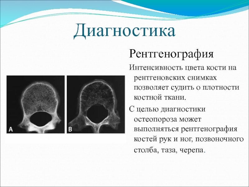 Объясните почему на рентгеновском снимке изображение костей получается белым