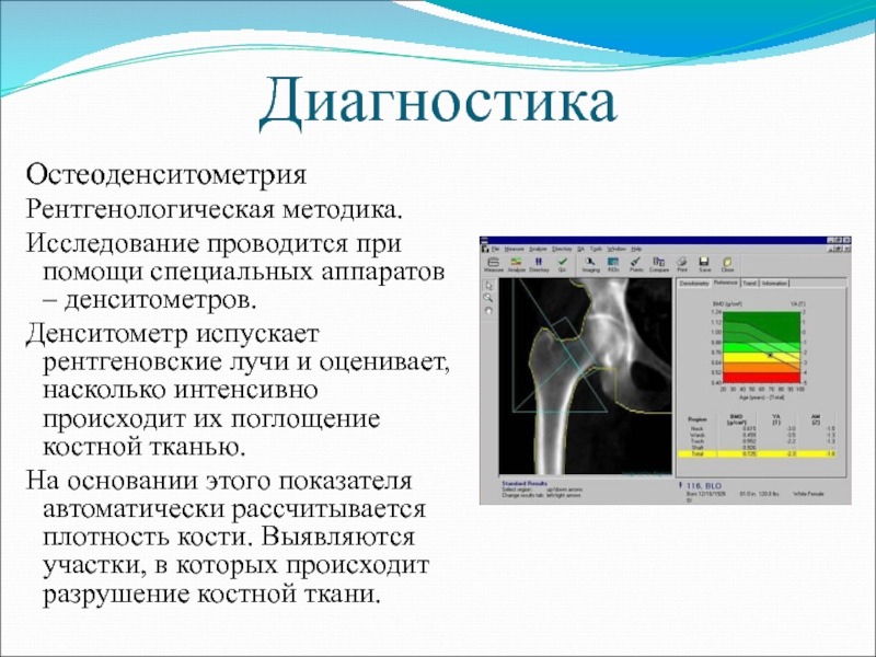 Денситометрия позвоночника. Рентген денситометрия расшифровка. Остеоденситометрия. Остеоденситометрия бедренной кости. Остеоденситометрия на кт.