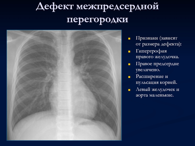 Увеличена правая. Гипертрофия правого желудочка рентген. Гипертрофия правого желудочка на рентгенограмме. Гипертрофия левого желудочка рентген. Дефект межпредсердной перегородки рентген.