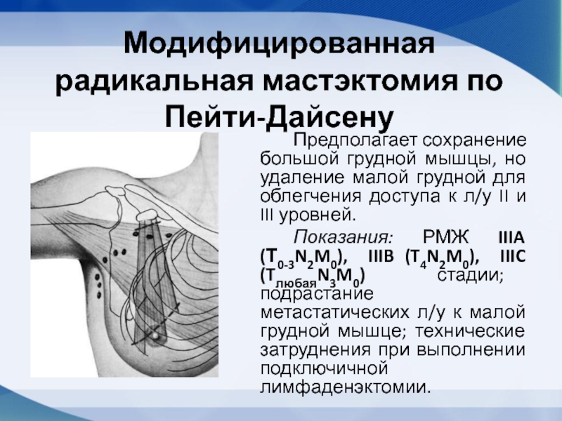 Мастэктомия по холстеду