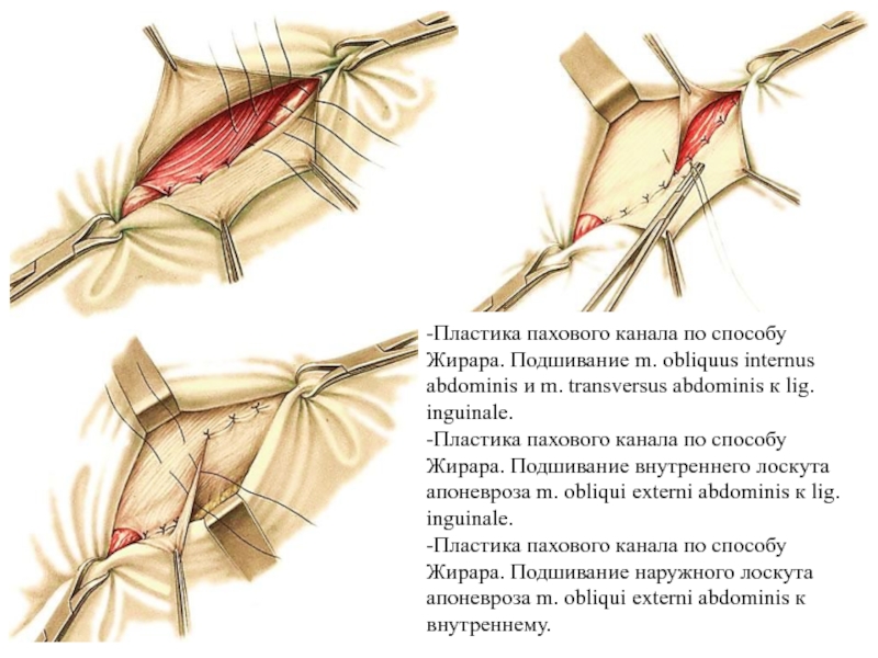 Obliquus internus abdominis