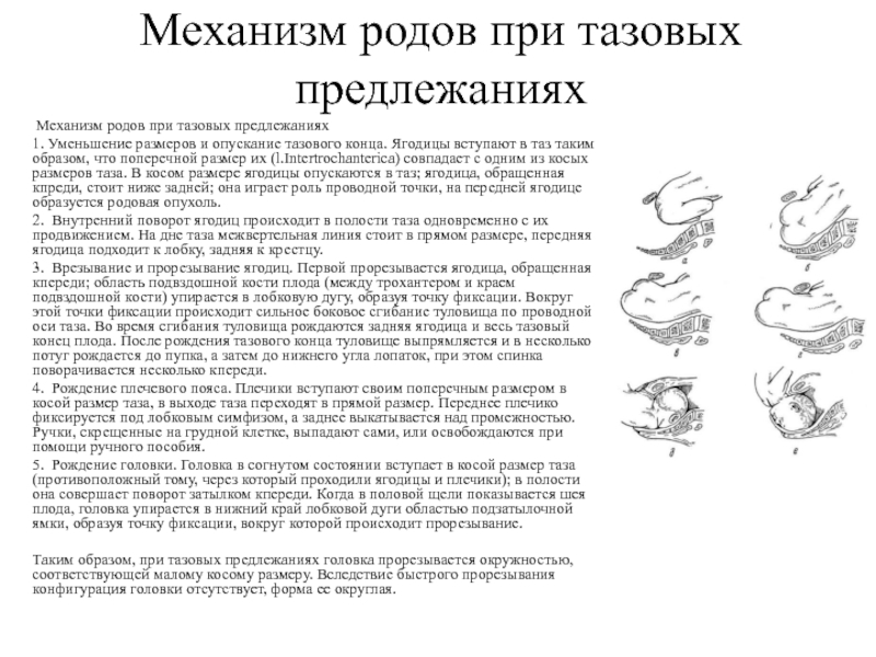 Тазовые роды. Ведение родов при тазовом предлежании. Родоразрешение при тазовом предлежании. Родоразрешение при ягодичном предлежании. Современные принципы ведения родов при тазовом предлежании.