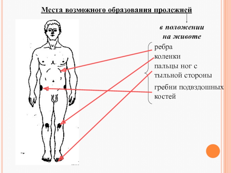 Места пролежней. Места возможного образования пролежней. Места возможного образования пролежней таблица. Места возможного образования пролежней в положении сидя. Места возможного образования пролежней обмываются.