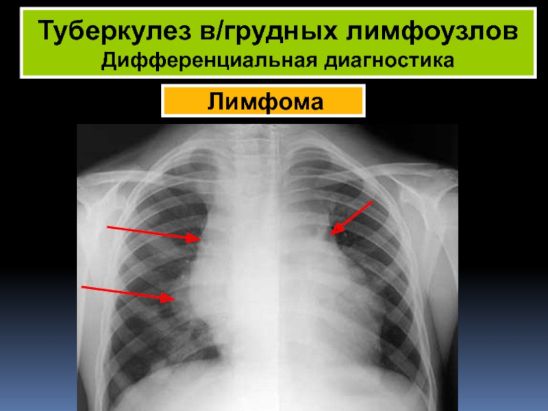 Туберкулез молочной. Туберкулёз грудных лимфоузлов. Туберкулез лимфатических узлов дифференциальная диагностика. Первичный туберкулезный комплекс диагностика. Туберкулез лимфатических узлов дифференциальный диагноз.