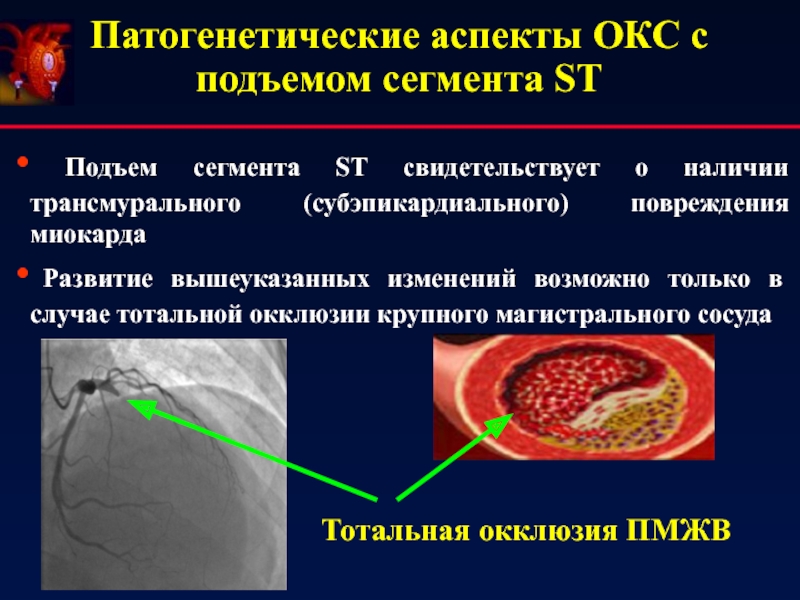 Главная причина развития острого коронарного синдрома. Острый коронарный синдром с подъемом сегмента St. Окс подъем сегмента St. Формы острого коронарного синдрома с подъемом сегмента St. Фармакотерапия острого коронарного синдрома с подъемом сегмента St.