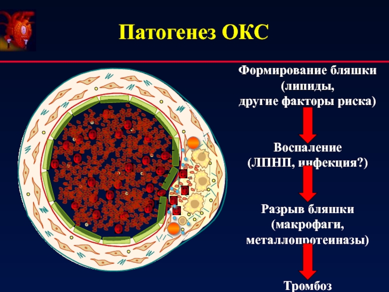 Развитие острого коронарного синдрома