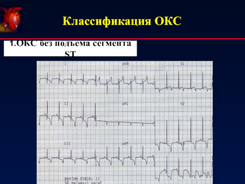 Карта вызова c окс c подъемом сегмента st