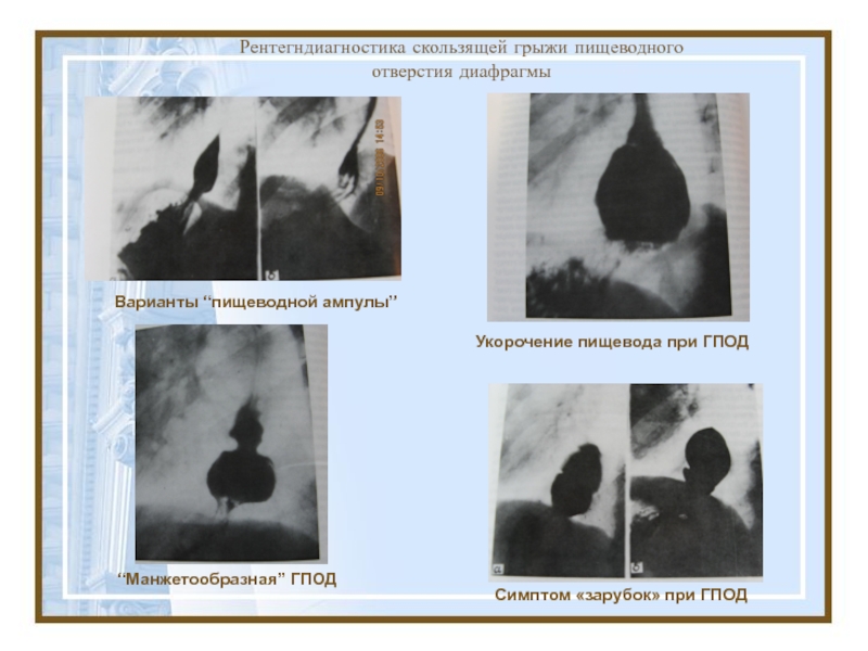 Спазм диафрагмы. Грыжа пищеводного отверстия диафрагмы симптомы.