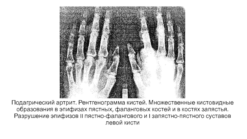 Кистовидные перестройки костей