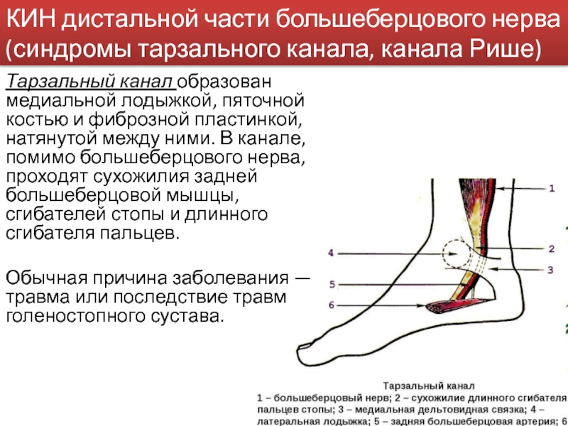 КИН дистальной части большеберцового нерва (синдромы тарзального канала, канала Рише) Тарзальный канал
