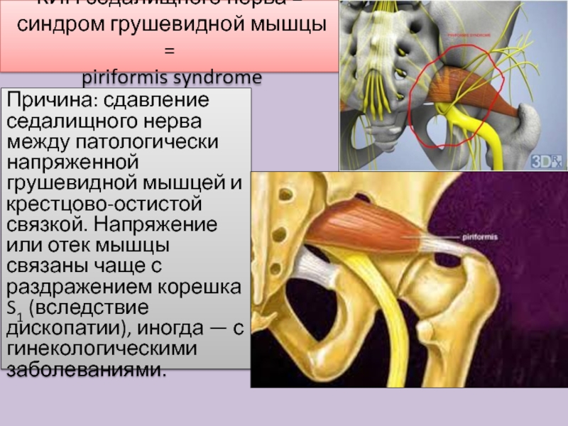 КИН седалищного нерва =  синдром грушевидной мышцы =  piriformis syndrome Причина: