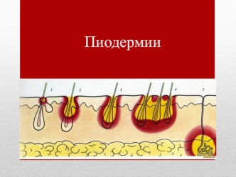 Пиодермии. Способствующие факторы