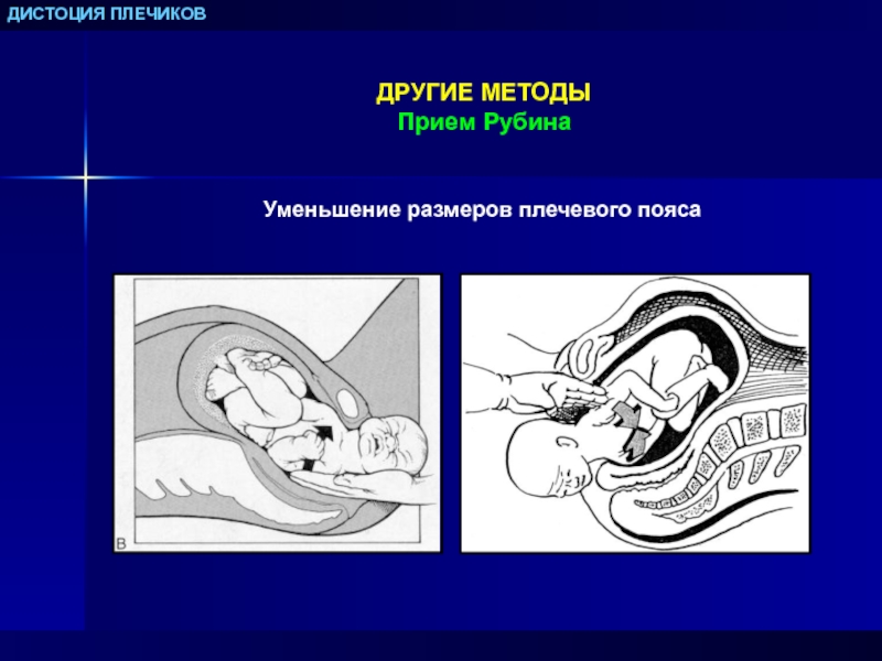 Дистоция плечиков презентация