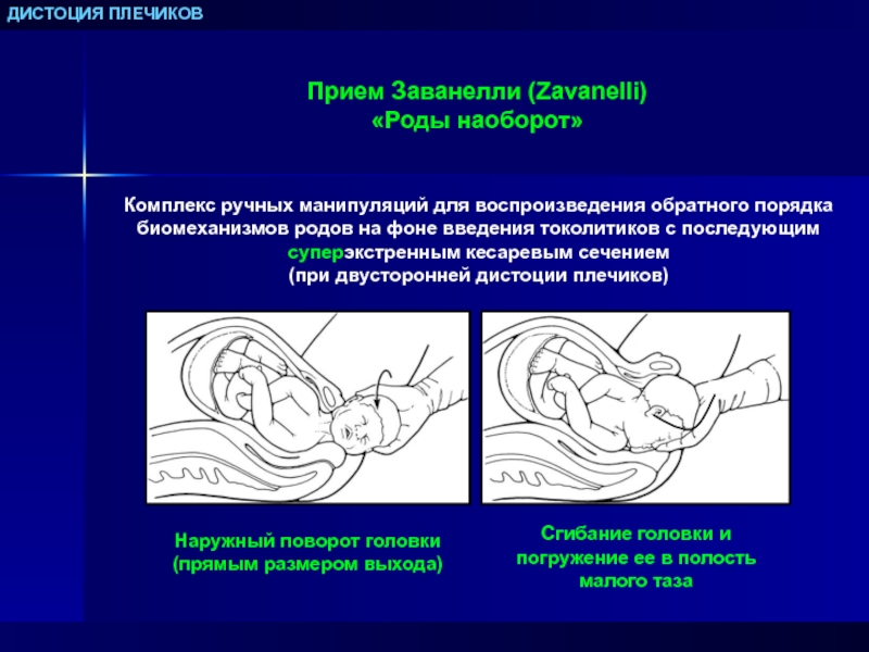 Дистоция плечиков презентация