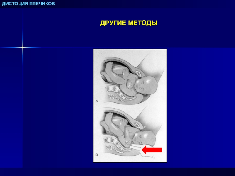 Дистоция плечиков тест