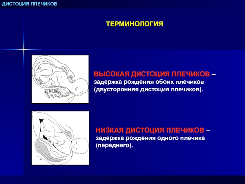 Дистоция плечиков презентация