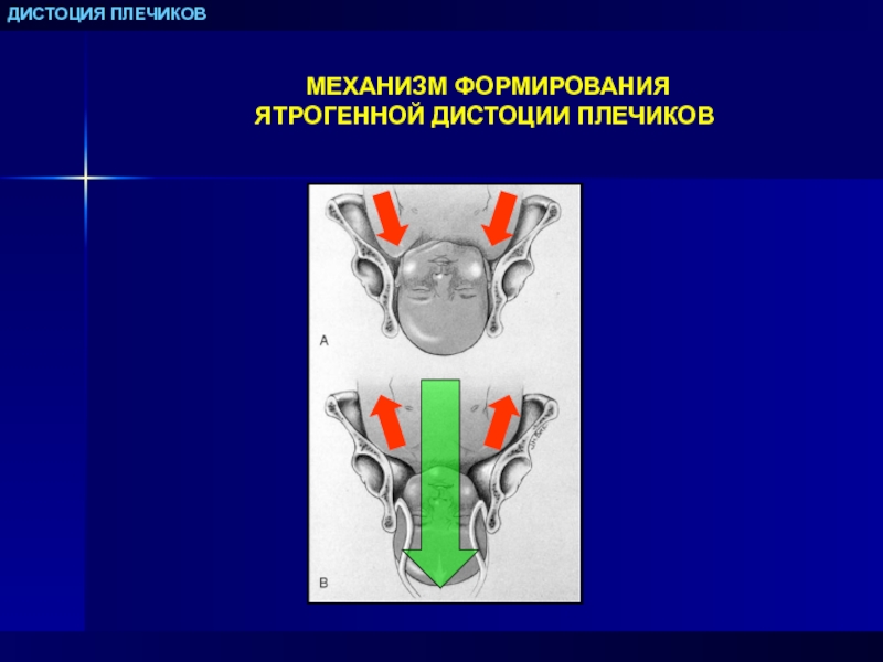 Дистоция плечиков презентация