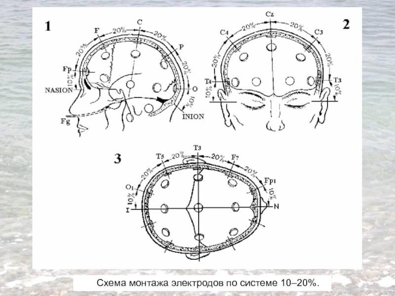 Схема 10 20 наложение электродов