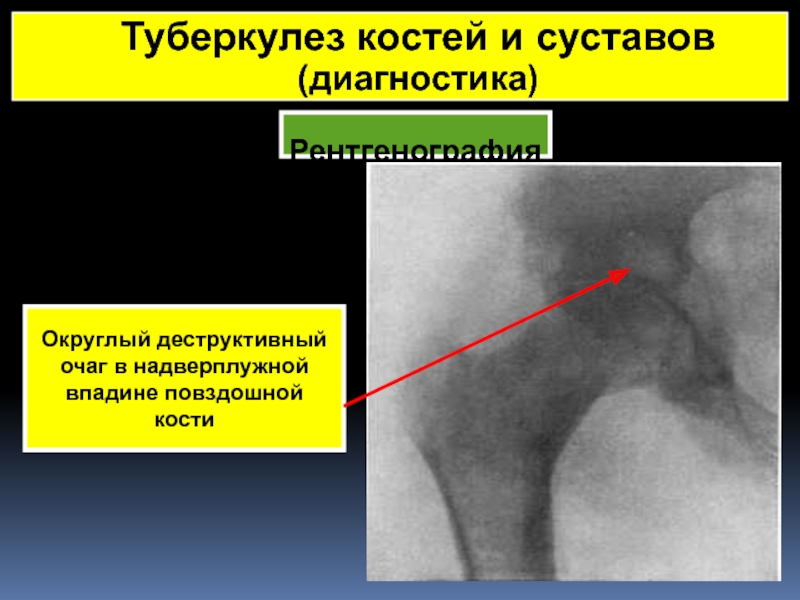 Туберкулез костей и суставов фото