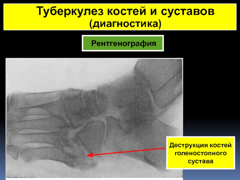 Туберкулез кости стопы. Туберкулез кости рентген. Костная деструкция рентген. Туберкулез суставов диагностика.