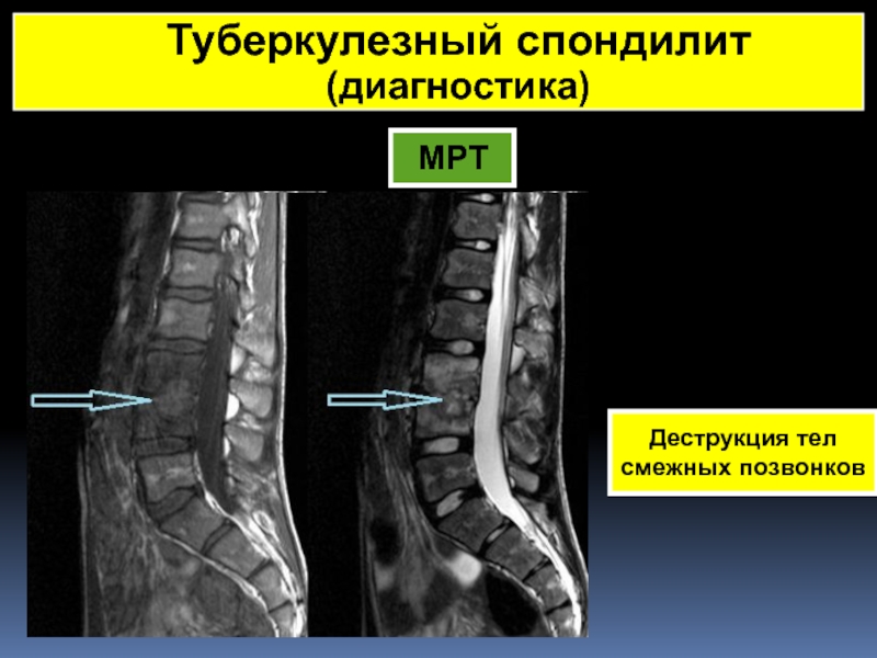 Спондилит. Спондилит поясничного отдела позвоночника мрт. Спондилит поясничного отдела кт. Метатуберкулезный спондилит.