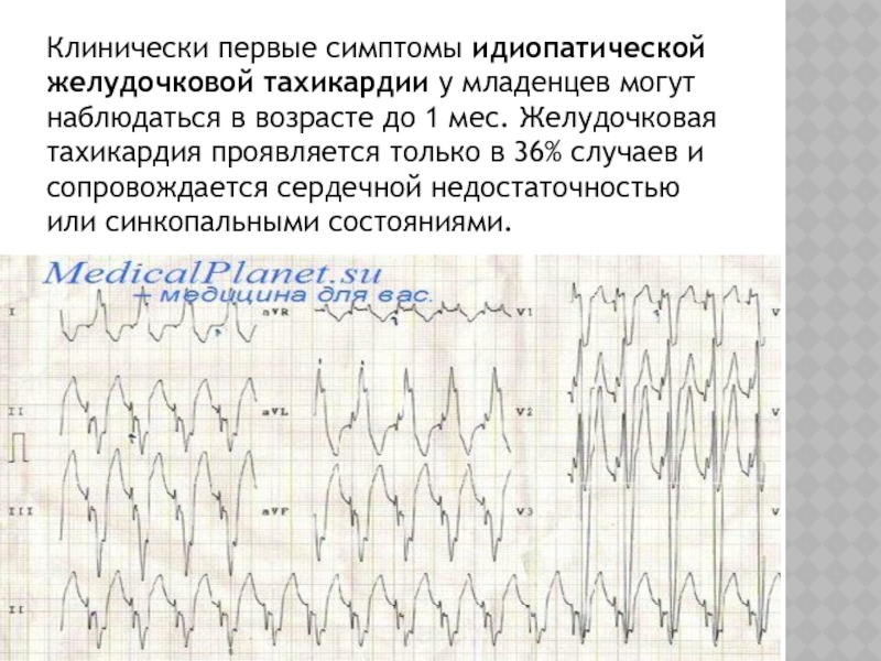 Желудочковые тахикардии презентация