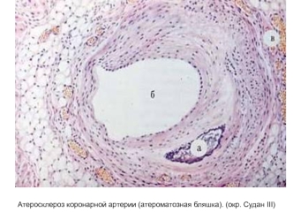 Атеросклероз коронарной артерии (атероматозная бляшка)