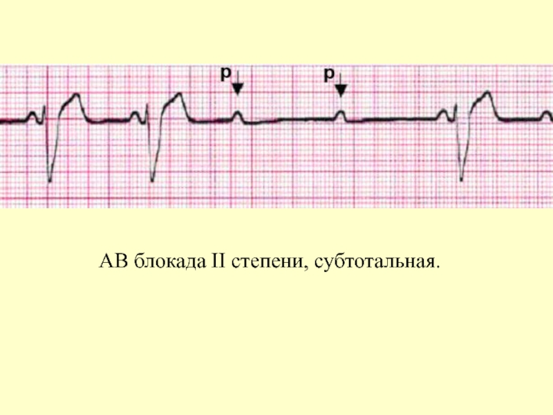 Ав блокады картинки