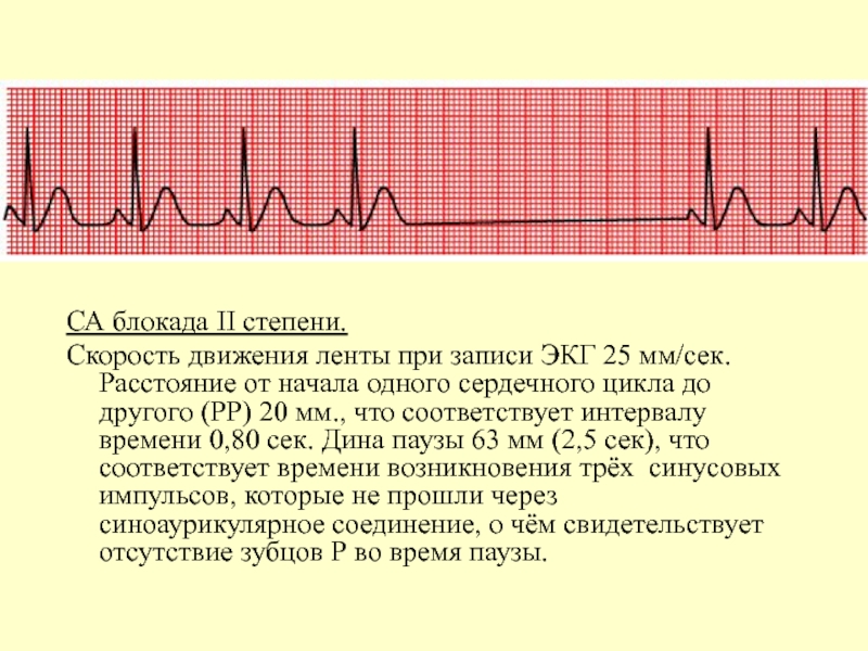 Са блокада 2 степени. Са блокада 2 степени Мобитц 1 на ЭКГ. Синоатриальная блокада Мобитц 1 ЭКГ. Са блокада 2 Мобитц 2. Синоатриальная блокада 2 степени ЧСС.