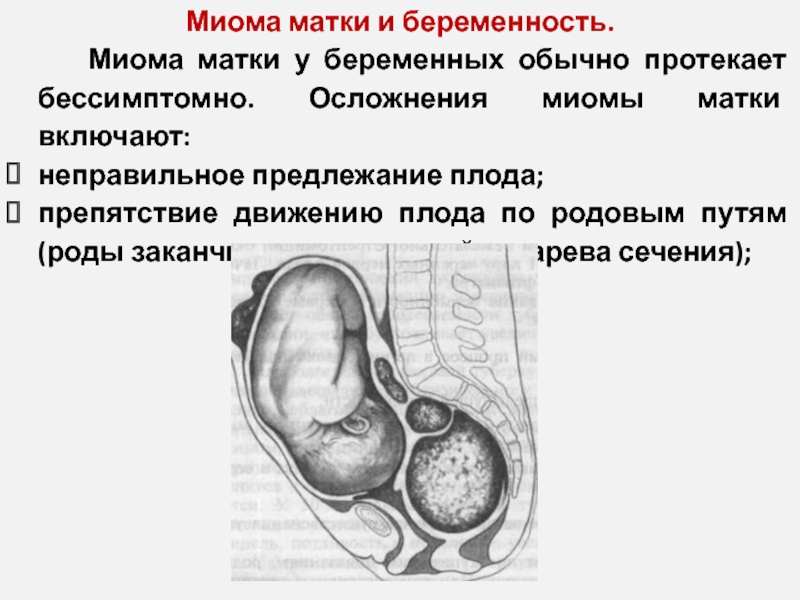 Миома и беременность. Миома матки и беременность. Осложнения лейомиомы матки. Осложнения миомэктомии.