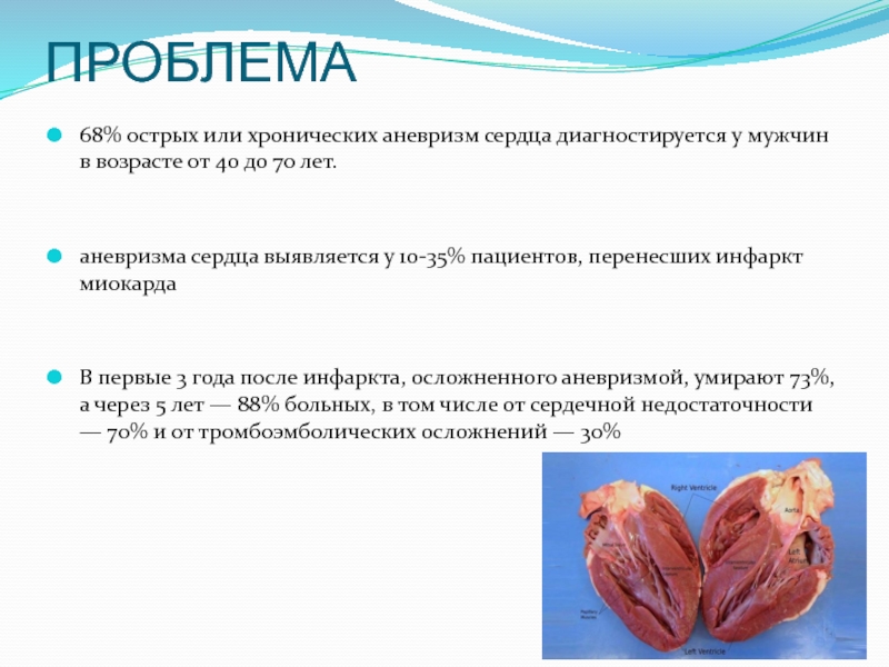 Картине истинной аневризмы в области верхушки миокарда левого желудочка соответствует