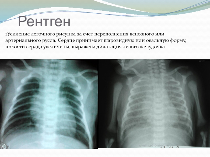 Усиление легочного. Рентгенологический признак кардита. Признак кардита на рентгене. Рентген рентгенографический признак кардита.