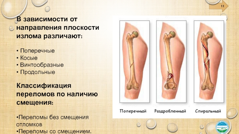 Винтообразный перелом