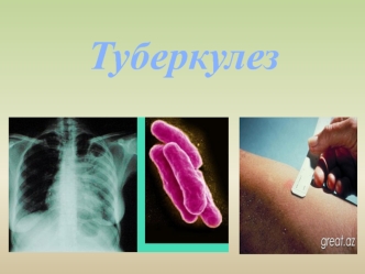 мереке туберкулез