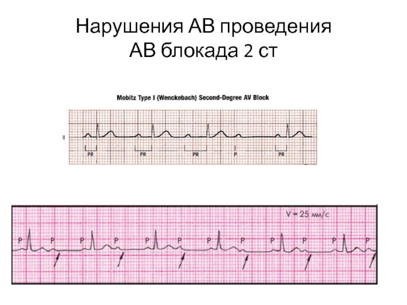 Ав блокада 2. АВ блокада 2 ст на ЭКГ. АВ блокада 2 степени Мобитц 1. ИБС АВ блокада. Av блокада 2 ст.