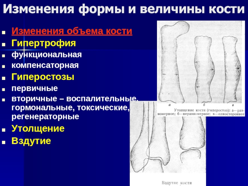 Изменения костей. Гиперостоз плюсневой кости. Гиперостоз большеберцовой кости на кт.