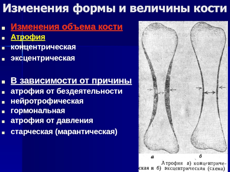 Изменения костей. Концентрическая атрофия. Концентрическая атрофия кости. Изменение формы и величины костей.