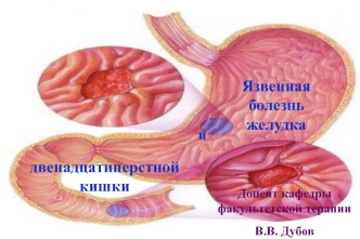 Язвенная болезнь желудка и двенадцатиперстной кишки