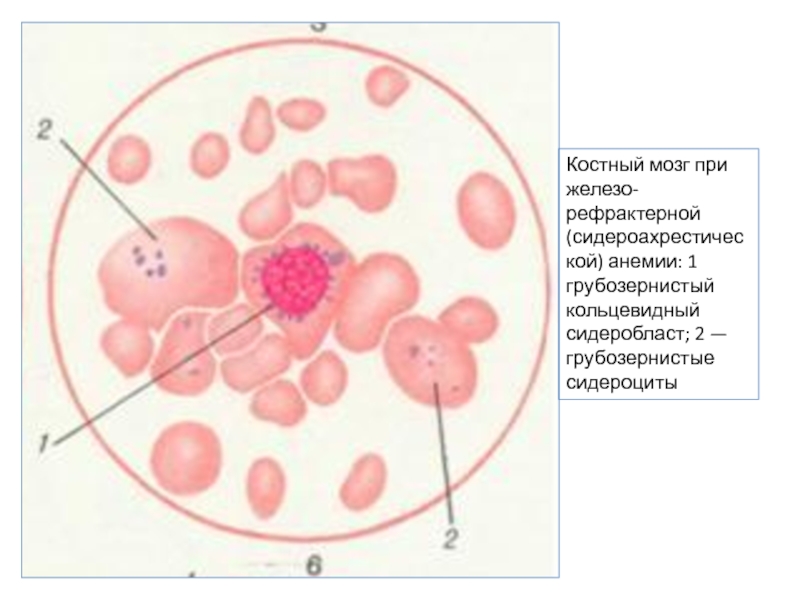 Сидероахрестические анемии причины механизмы развития клиника картина крови