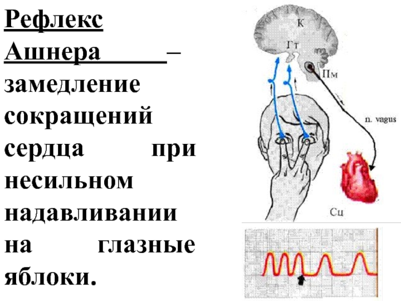 Нажатие на глазные яблоки