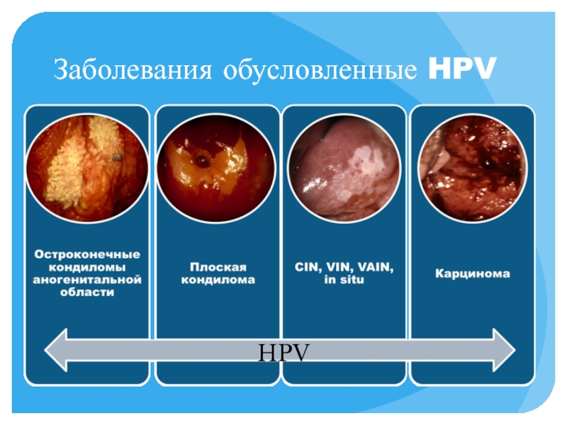 Реферат: Сексуально-трансмиссивные расстройства Вирус папилломы человека