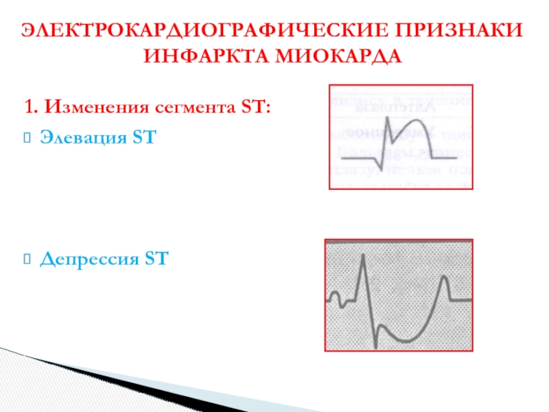 Депрессия st. Инфаркт ЭКГ элевация St. Элевация сегмента St при инфаркте миокарда. ЭКГ инфаркта миокарда элевация сегмента St. Депрессия сегмента St элевация сегмента St инфаркт миокарда.