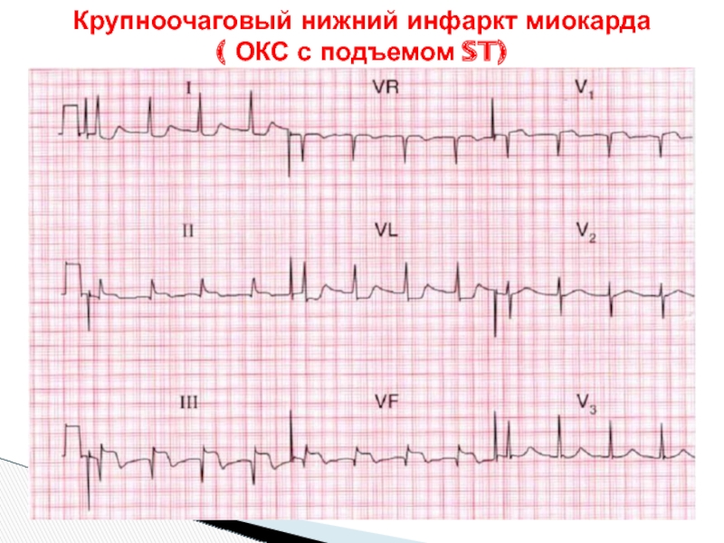 Окс без подъема st карта вызова скорой