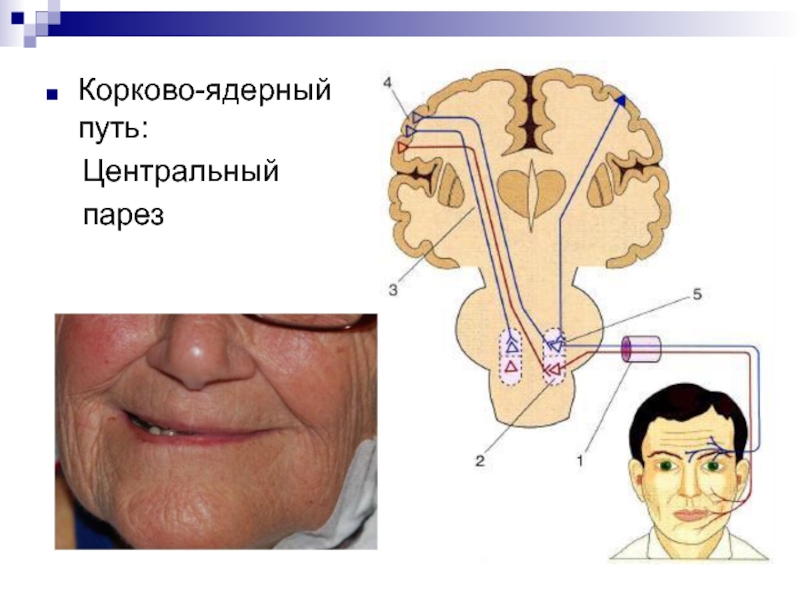 Центральный путь. Корково ядерный путь. Поражение корково ядерного пути. Кортико нуклеарный путь. Пирамидный корково ядерный путь поражения.