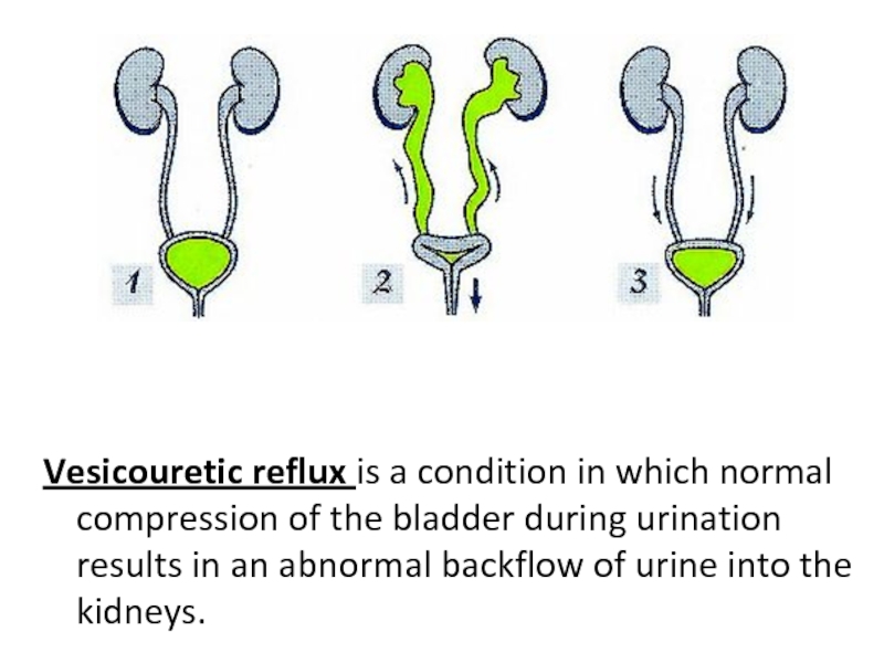 condition in which normal compression of the bladder during urination resul...