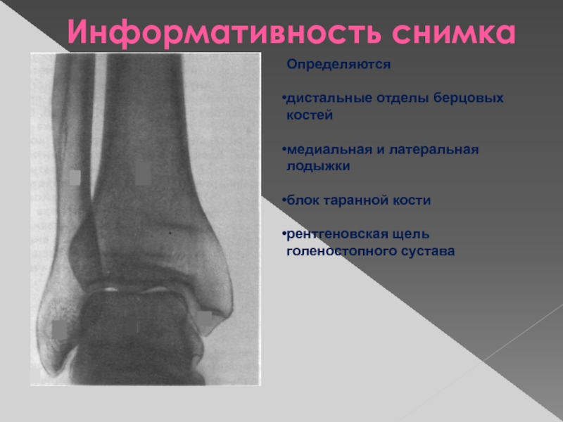 Суставная щель голеностопного сустава